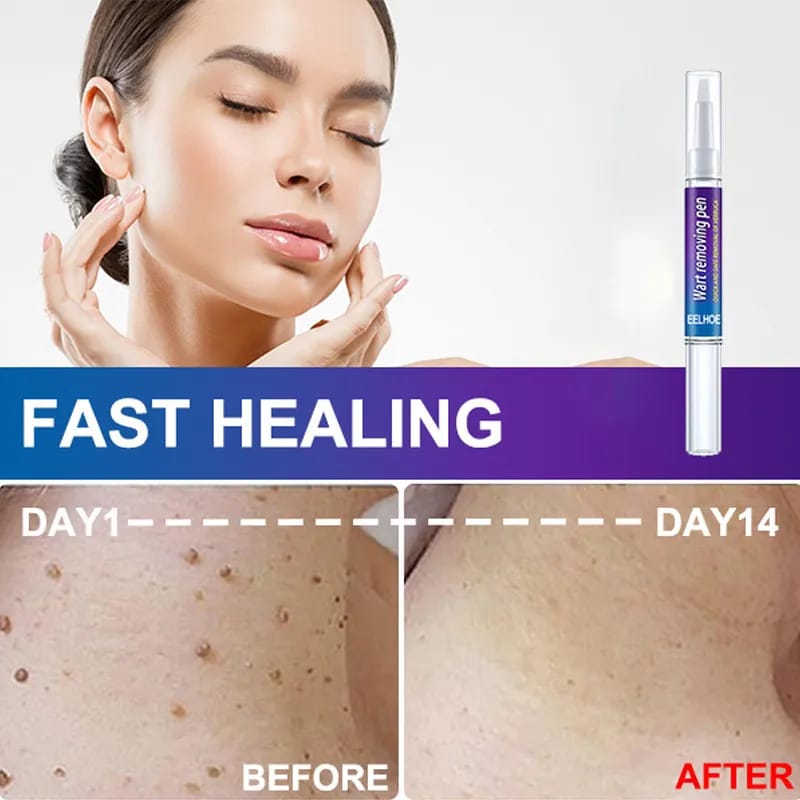 Skin Tag, Mole & Wart Remover Pen