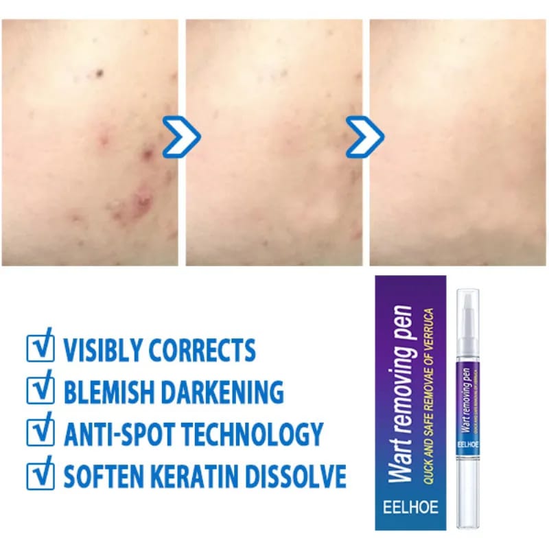 Skin Tag, Mole & Wart Remover Pen