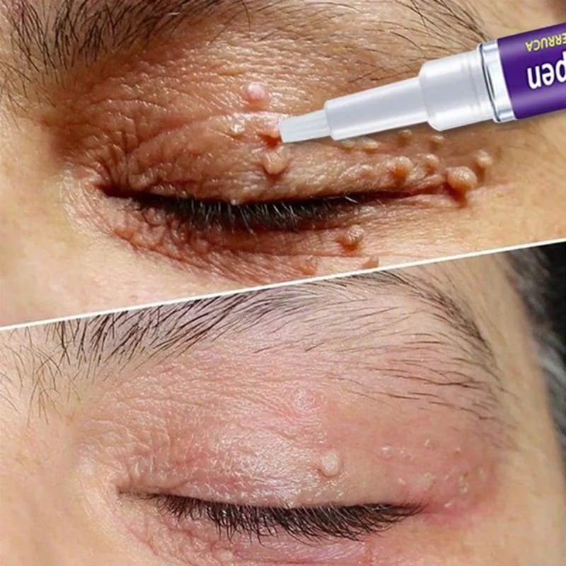 Skin Tag, Mole & Wart Remover Pen